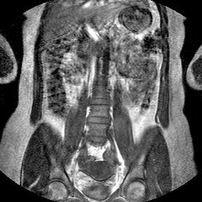 تصویر MRI بیمار